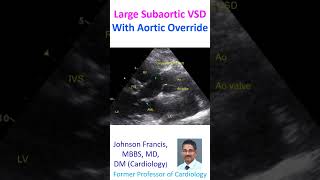 Large subaortic VSD with aortic override [upl. by Akihsal]