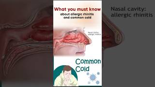 Allergic rhinitis and common coldPart1alergic cold commoncold rhinitis [upl. by Notyalc]