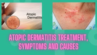 Atopic dermatitis treatment symptoms and causes  Nuse Healthy [upl. by Jocelyne]