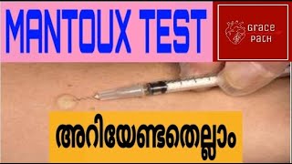 Mantoux Test  Tuberculin Skin Test TST Malayalam [upl. by Retla]