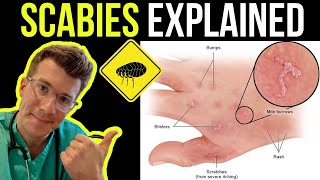 Doctor explains SCABIES skin rash including SYMPTOMS PHOTOS OF SKIN TREATMENT amp more [upl. by Rockafellow986]