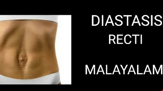 Diastasis recti malayalam capsule version [upl. by Issor364]