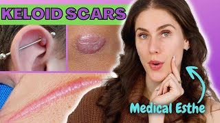 How To Treat Keloid Scars At Home  Is It Possible Why Do Keloid Scars Happen [upl. by Rivard637]