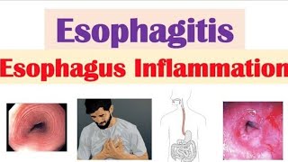 Esophagitis [upl. by Ermine]