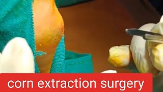 corn extraction surgery  corn callus removal surgery  doctor youtube dr [upl. by Einahpit]