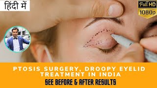 हिंदी में Ptosis Surgery Droopy Eyelid Treatment in India  Before amp After Results TEC [upl. by Arnulfo167]