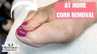 Corn Removal at Home on Toe [upl. by Kciredor149]