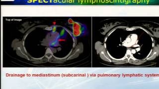 Lymphoscintigraphy with SPECTCT in Malignant Melanoma [upl. by Yerg455]