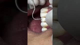 Broken Teeth Treatment Part 2 DentalDignify dentist dentistry veneers [upl. by Eirallih]