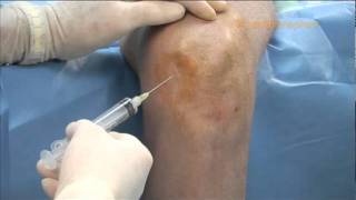 Inferior Medial Injection Technique [upl. by Rehptosirhc]