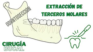 ODONTOSECCIÓN Técnica de extracción de Terceros Molares  Dr Han Choi [upl. by Kingdon]