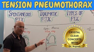 Tension pneumothorax  Causes Clinical Correlations  Emergency Treatment🩺 [upl. by Alurta]