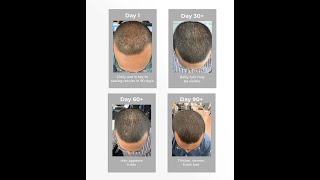 Ultimate Hair Regrowth and Hairline Restoration  Beard Growth Morphic Field [upl. by Bryant286]