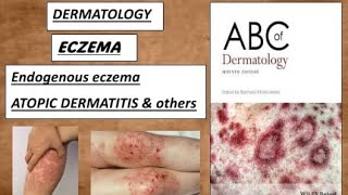 DERMATOLOGY  ENDOGENOUS ECZEMA  Atopic dermatitis amp other types derma eczema dermatitis [upl. by Woolson]