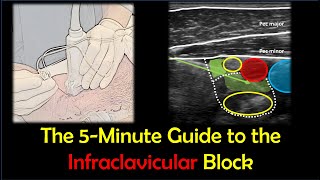 Infraclavicular Brachial Plexus Block  a quotHowToquot Guide [upl. by Nerot]