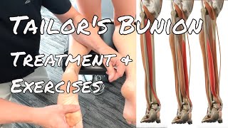 Tailors Bunion  Treatment amp Exercises [upl. by Sidonie716]