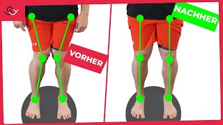 X Beine loswerden  Mit diesen 2 einfachen Übungen [upl. by Aiksas]