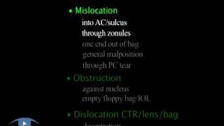 Capsular Tension Rings Complications Phaco 34 Complications [upl. by Lhary65]