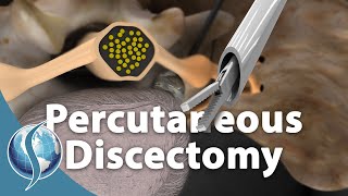 Is Percutaneous Discectomy Better Than Traditional Discectomy [upl. by Anitram]