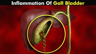 Cholecystitis Gallbladder Inflammation  Symptoms Causes and Treatment UrduHindi [upl. by Sulihpoeht961]