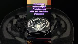 Cholelithiasis Hepatomegaly Prostatomegaly Abd wall Herniation of omentum trending ctscan [upl. by Templa80]