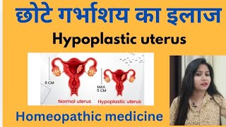 छोटे गर्भाशय का इलाज  Small uterus symptomscauses amp homeopathic medicine in hindi [upl. by Suiluj]