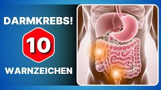 10 Symptome die zeigen dass Sie dringend eine Koloskopie machen müssen [upl. by Hehre]