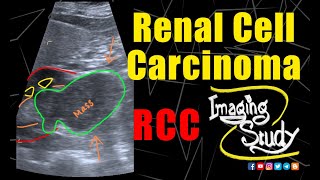 Renal Cell Carcinoma  RCC  Ultrasound  CT  Case 197 [upl. by Ennaegroeg]