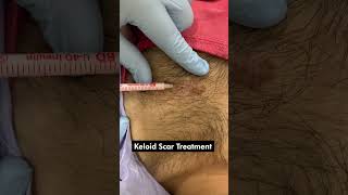 Effective Keloid Scar Treatment Injection  Keloid Removal Treatment  Skinaa Clinic viral short [upl. by Henrie559]