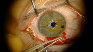 Astigmatic Keratotomy Long Scleral tunnel for astigmatism reduction [upl. by Dinsdale]