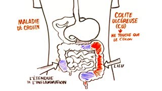 Maladie Inflammatoire de Lintestin MII [upl. by Getraer463]