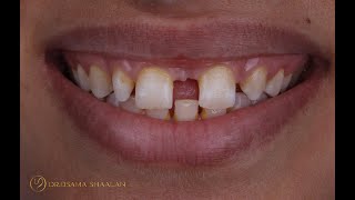 Combined approach for large diastema closure part II [upl. by Corley]