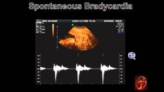 Fetal Echocardiograph Common Fetal Arrhythmias [upl. by Chae]