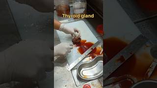 Cystic thyroid gland gross pathology [upl. by Tenahs583]