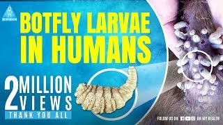 botfly larvae in humans [upl. by Anillehs389]