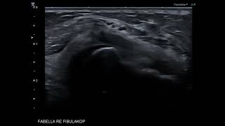 Nerve ultrasound case  fibular peroneal nerve entrapment and a fabella [upl. by Enitsirhc]