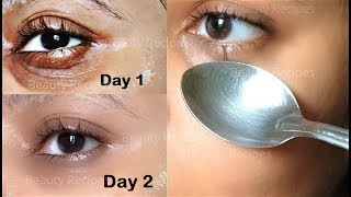 How to Remove Under Eye WRINKLES Under Eye Bags Puffy eyes amp Dark Circles in 1 Day with ice cubes [upl. by Tik865]