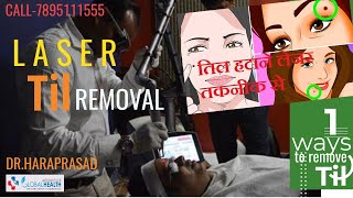 Laser Til ampMole Removal by Nd YAG Laser अनचाहे तिलों को हटाए मिनटों मेंGlobal Health Aesthetics [upl. by Nnuahs]