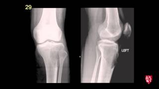 Radiology Boards Prep  MSK Cases [upl. by Eirellav]