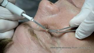 Soft fibroma  removal by highfrequency electrosurgery [upl. by Mariken]