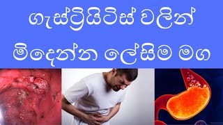 How to get rid of gastritis completely  Gastritis sinhala online learning [upl. by Ativel]