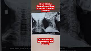 neck xray cervical spondylosis physiotherapy cervicalspondylosis [upl. by Llewkcor]