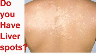 Liver spots pityriasis versicolor causes and treatment [upl. by Otreblide619]