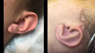 Dr Sherrell Aston Otoplasty Ear Pinning Surgery Before and After [upl. by Edeline]