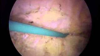 Arthroscopic Lateral Release and Medial Imbrication  ORV  Michael Magoline MD [upl. by Kimbra]