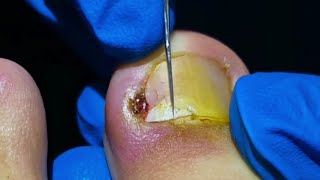 Watch PROFESSIONAL Pedicurist Remove Huge Ingrown Toenail [upl. by Notserk]