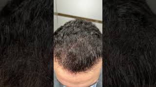 Medikemos Clinic  Hair Transplantation Result [upl. by Calv]