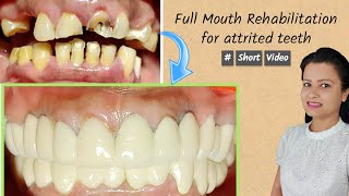 full mouth rehabilitation for attrited teeth  shorts [upl. by Ymer]