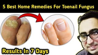 Top 5 Remedies To Cure Nail Fungus Just In 7 Days At Home  Pharmacist Javaid [upl. by Adnak]