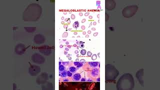 megaloblastic Anemia pathology anemia mbbs need t202learning shorts neetpg hematology [upl. by Mixam906]